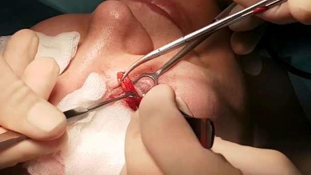 The surgeon is performing an operation on the eyes, close-up. Correction of. The doctor does blepharoplasty. Operation in the operating room. — Stock Video