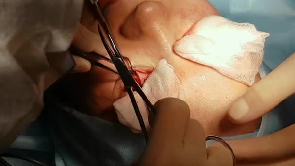 The surgeon is performing an operation on the eyes, close-up. Correction of. The doctor does blepharoplasty. Operation in the operating room. — Stock Video