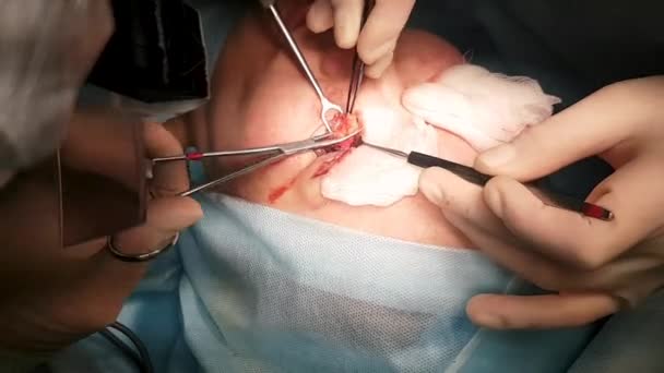 Хирург проводит операцию на глазах крупным планом. Поправка. Врач делает блефаропластику. Работа в операционной . — стоковое видео