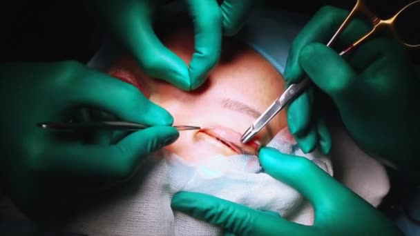 눈에 대 한 작업을 수행 하는 외과 의사 클로즈업. 정정입니다. 의사는 안 검 성형을 한다. 수술 실에서 작업. — 비디오