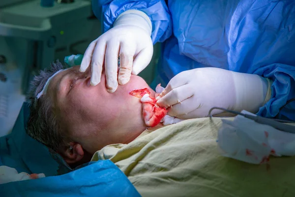 Réduction du menton augmentation double retrait du menton chirurgie plastique opération cosmétique concept. Chirurgie du menton gros plan avec plaie ouverte . — Photo