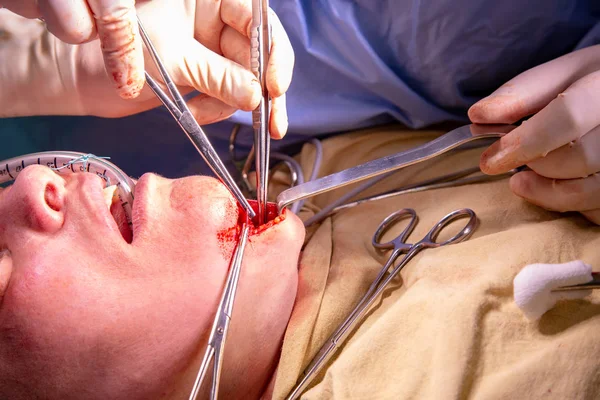 Aumento Redução Queixo Remoção Queixo Duplo Cirurgia Plástica Conceito Operação — Fotografia de Stock