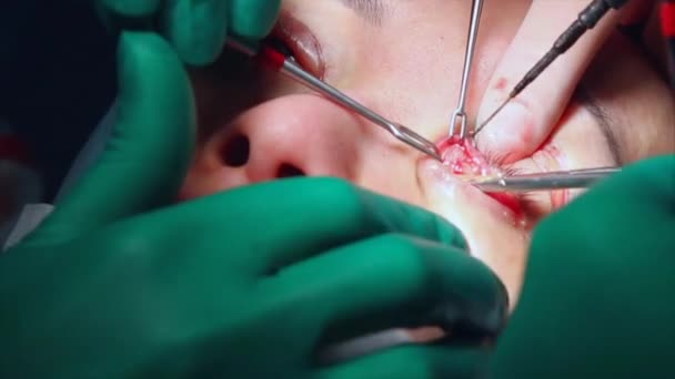 눈에 대 한 작업을 수행 하는 외과 의사 클로즈업. 교정 의사는 안 검 성형 눈. 수술 실에서 작업입니다. 메스와 클램프 눈동자에 가까움. — 비디오