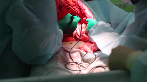 Abdominoplasti karın. Karın yağ aldırma. Karın yağ ve müköz dokuların kısmi kaldırma. Doktor bir lazer cerrahi neşter keser. — Stok video