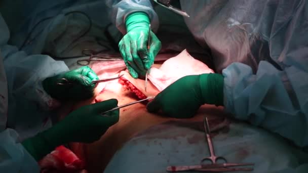 Abdominoplastia del abdomen. Liposucción abdominal. Extracción parcial de la grasa y los tejidos mucosos del abdomen. El médico corta un bisturí quirúrgico con láser . — Vídeo de stock