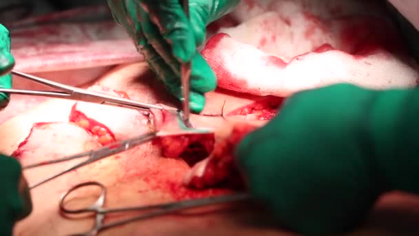 Abdominoplastie de l'abdomen. Liposuccion abdominale. Enlèvement partiel des tissus adipeux et muqueux de l'abdomen. Le médecin coupe un scalpel chirurgical au laser . — Video