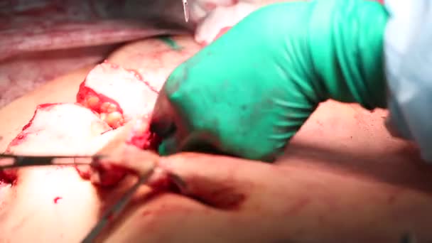 Abdominoplastia Del Abdomen Liposucción Abdominal Extracción Parcial Grasa Los Tejidos — Vídeo de stock