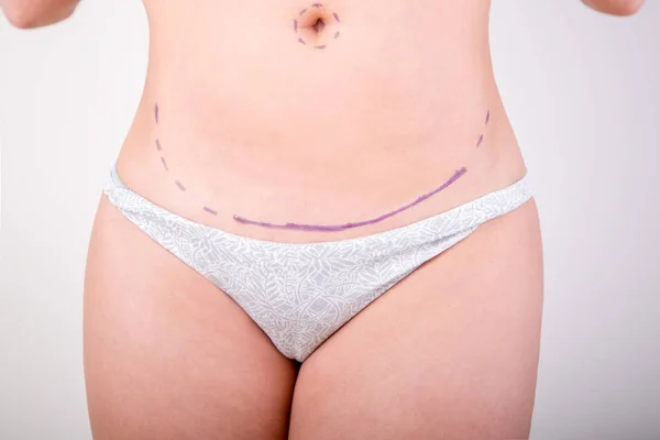 Surgeon drawing marks on female body before plastic operation, white background. Beautician touch and draw correction lines on womans buttocks.