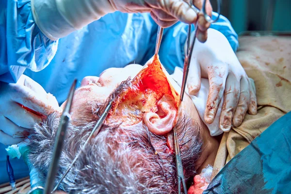 Obličejové plastické chirurgie operace. operace obličeje. — Stock fotografie