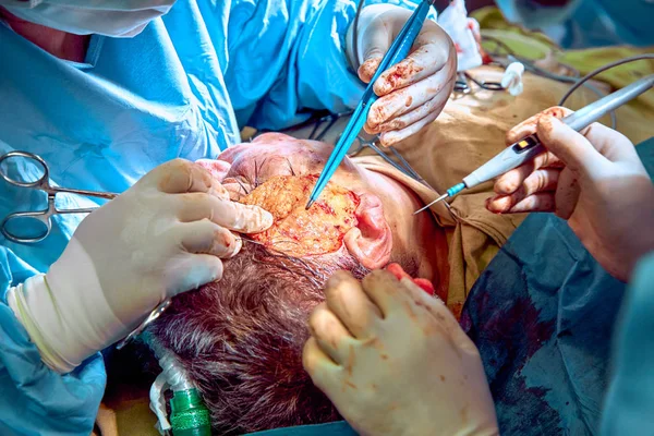 Cirugía plástica facial. Cirugía de lifting facial. Cirujano separó la piel de la cara de los pacientes —  Fotos de Stock
