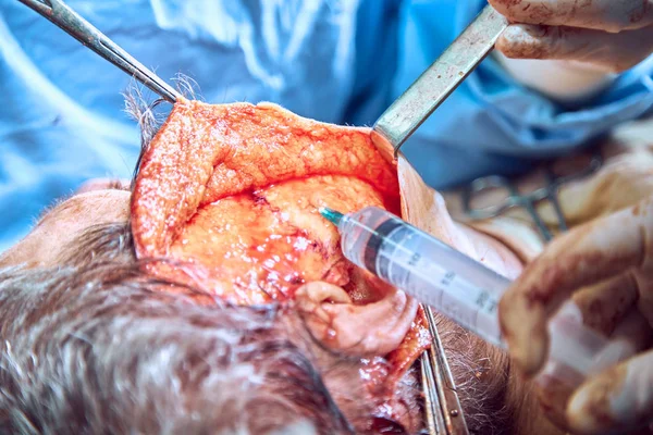 Arc Plasztikai Sebészet Működését Face Lift Műtét — Stock Fotó