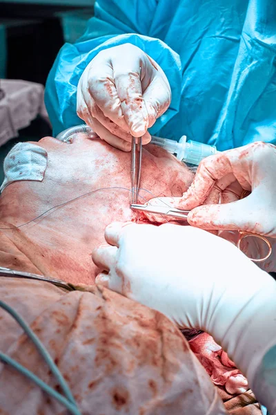 Cirugía plástica facial. Cirugía de lifting facial. Cirujano separó la piel de la cara de los pacientes — Foto de Stock