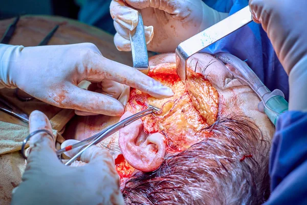顔の整形手術操作。フェイス リフト手術。外科医が患者の顔から皮膚を分離 — ストック写真