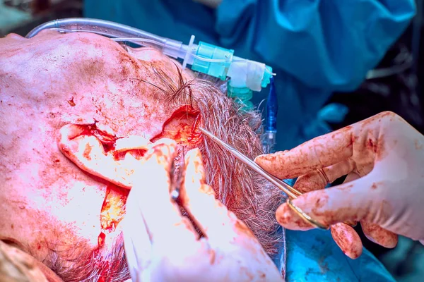 Obličejové plastické chirurgie operace. Face lift operaci. Chirurg oddělené kůži z obličeje pacienti — Stock fotografie