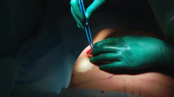 Χειρουργός και χειρουργική ομάδα εκτέλεση πλαστικής χειρουργικής επέμβασης στα στήθη σε λειτουργικό δωμάτιο νοσοκομείου. Αύξηση του μαστού. Mammoplasty. Διεύρυνση του μαστού. Χειρουργική λεπτομέρεια. — Αρχείο Βίντεο