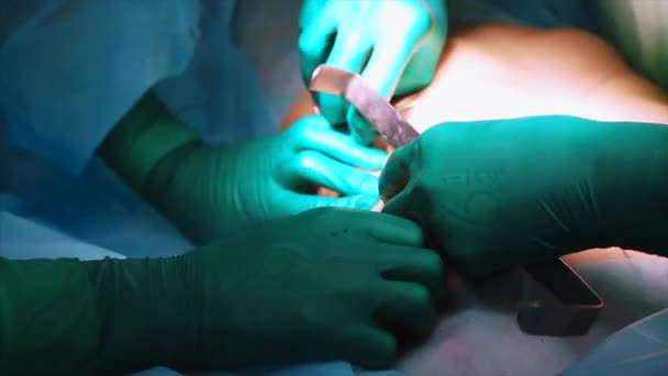 Cirujano y equipo quirúrgico están realizando cirugía estética en los senos en el quirófano del hospital. Instalación de drenaje. Aumento de senos. Mamoplastia. Ampliación de senos. Detalle de cirugía . — Vídeos de Stock