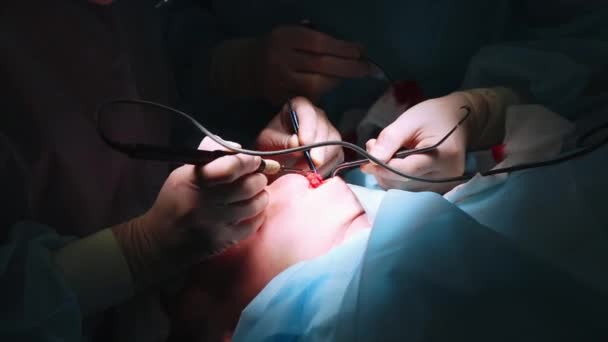 Cirurgia de levantamento facial. Tiro de close-up na sala de cirurgia da mesa cirúrgica com paciente. Cirurgia em andamento . — Vídeo de Stock