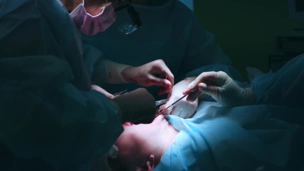 Face lifting chirurgia. Zbliżenie na sali operacyjnej stolik manipulacyjny z pacjentem. Operacja w toku. — Wideo stockowe