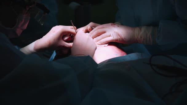 Close-up Shot in de operatiekamer van chirurgische tafel met instrumenten, assistent handen uit instrumenten aan chirurgen tijdens de operatie. Operatie aan de gang. — Stockvideo