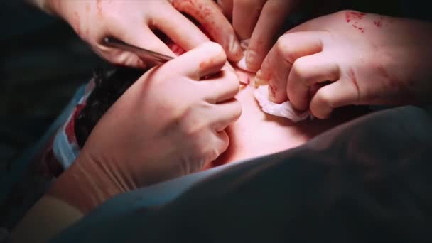 Opheffing van de chirurgie van het gezicht. Close-up Shot in de operatiekamer van chirurgische tabel met patiënt. Operatie aan de gang. — Stockvideo