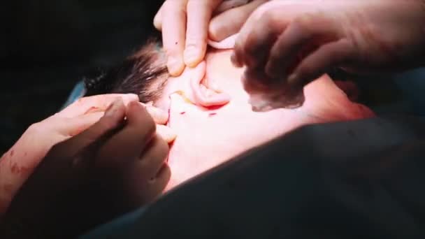 Ansikte lyft kirurgi. Närbild skjuten i operationssalen av operationsbord med patienten. Kirurgi pågår. — Stockvideo