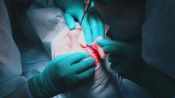 De chirurg is er een bewerking op de ogen, close-up. De dokter doet blepharoplastiek. Operatie in de operatiekamer. Vasculaire stolling tijdens blepharoplastiek chirurgie. — Stockvideo