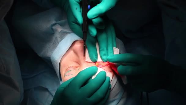 Der Chirurg führt eine Operation an den Augen durch, in Großaufnahme. der Arzt führt Blepharoplastik durch. Operation im Operationssaal. Gefäßgerinnung während der Blepharoplastik-Operation. — Stockvideo