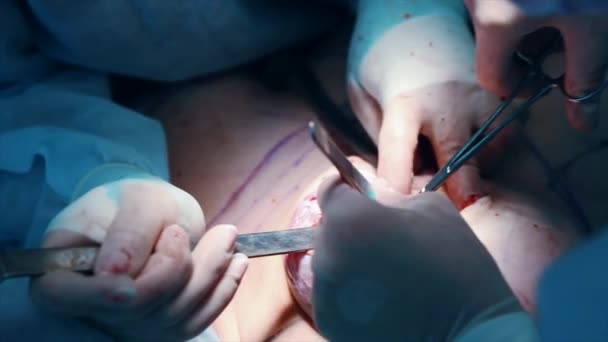 Borstimplantaat. Wegnemen van een kwaadaardige tumor van de melkklier. Installatie van een borst implantaat na verwijdering van een tumor, close-up — Stockvideo