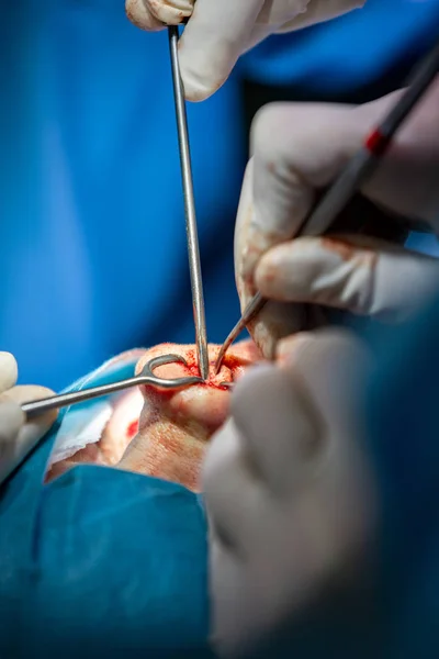 Cirujano y su asistente realizando cirugía estética en la nariz en el quirófano del hospital. Remodelación de la nariz, aumento. Rinoplastia . —  Fotos de Stock