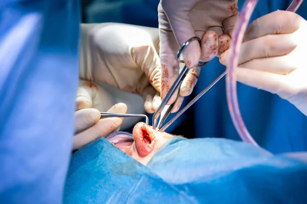 Rhinoplasty close-up of nose surgery. The hands of the surgeon working tools in white gloves, stitched — Stock Photo, Image