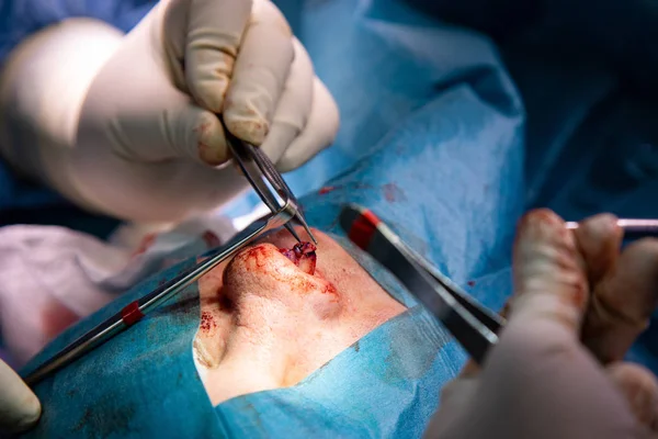 Rhinoplastie gros plan de la chirurgie du nez. Les mains du chirurgien outils de travail en gants blancs, cousu — Photo