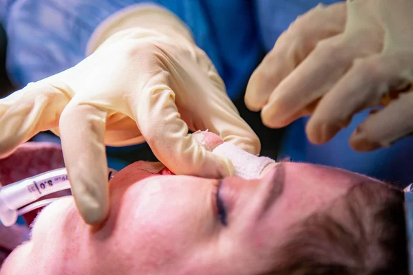 Cirujano y su asistente realizando cirugía estética en la nariz en el quirófano del hospital. Remodelación de la nariz, aumento. Rinoplastia . —  Fotos de Stock