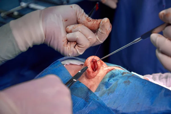Surgeon and his assistant performing cosmetic surgery on nose in hospital operating room. Nose reshaping, augmentation. Rhinoplasty. — Stock Photo, Image