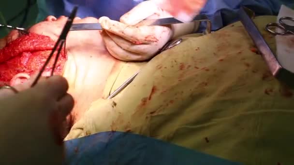 Plastische chirurgie om het gezicht op te tillen. Een team van chirurgen voerde een facelift operatie uit. Close-up, blauw licht. — Stockvideo
