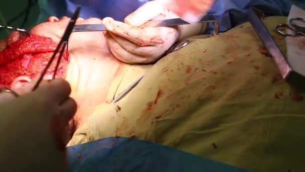 Chirurgie plastique pour soulever le visage. Une équipe de chirurgiens a pratiqué une opération de lifting. Gros plan, lumière bleue . — Video