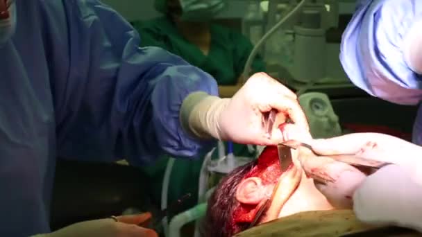 Chirurgie plastique pour soulever le visage. Une équipe de chirurgiens a pratiqué une opération de lifting. Gros plan, lumière bleue . — Video