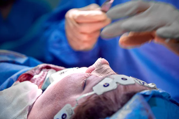 Nasenkorrektur Nahaufnahme der Nasenoperation. die Hände des Chirurgen Arbeitswerkzeuge in weißen Handschuhen, genäht — Stockfoto