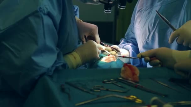 In de operatiekamer, twee chirurgen tijdens een bewerking. Professionele artsen in een modern ziekenhuis. Plastische chirurgie, moderne medetsin,. professioneel team van artsen. Concept schoonheid, gezondheid. — Stockvideo