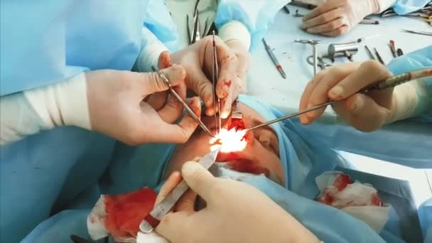 Colpo ravvicinato di naso nel sangue durante l'operazione plastica. Due chirurghi professionisti stanno facendo del loro meglio . — Video Stock
