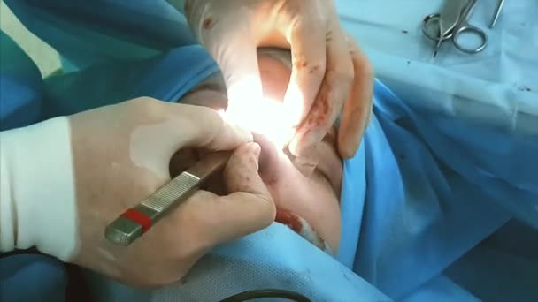 Nahaufnahme einer blutverschmierten Nase während einer plastischen Operation. Zwei Chirurgen geben ihr Bestes. — Stockvideo