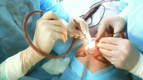 Close-up shot van de hand van artsen, die is betrokken bij een neuscorrectie van de neus in het ziekenhuis — Stockvideo