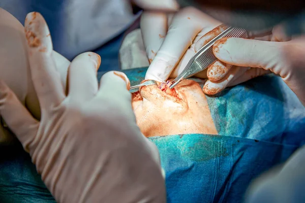 Nosorožecká plastika zblízka. Skutečná operace, tým chirurgů provádí operaci nosu. Moderní medicína, zdraví. — Stock fotografie