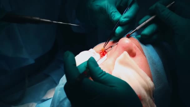 Der Chirurg führt eine Operation an den Augen durch, in Großaufnahme. Korrektur der. der Arzt führt Blepharoplastik durch. Operation im Operationssaal. — Stockvideo