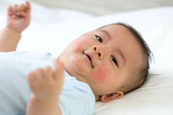 Bayi memiliki reaksi alergi terhadap wajah, Kulit ruam dalam konsep bayi — Stok Foto