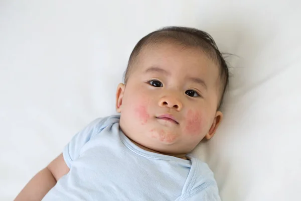 Aziatische baby jongen liggend op het bed en had een rode uitslag op het gezicht, huid gemeenschappelijke uitslag in pasgeboren concept — Stockfoto