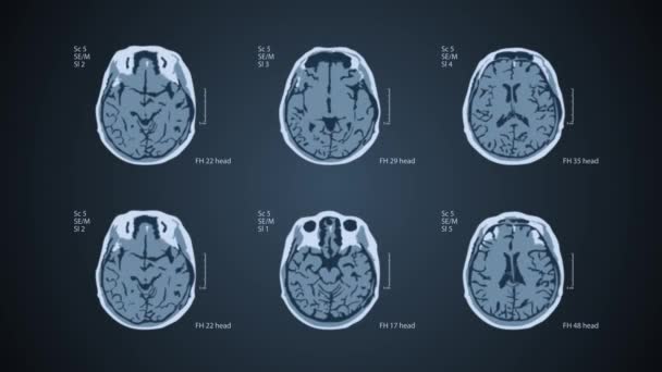 TAC cerebral. 6 vistas en una pantalla. Fondo azul médico 4k — Vídeo de stock