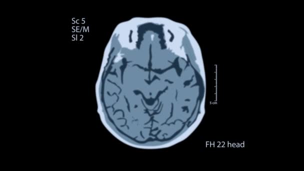 Rastreamento cerebral. Uma vista na tela preta. 4k formação médica — Vídeo de Stock