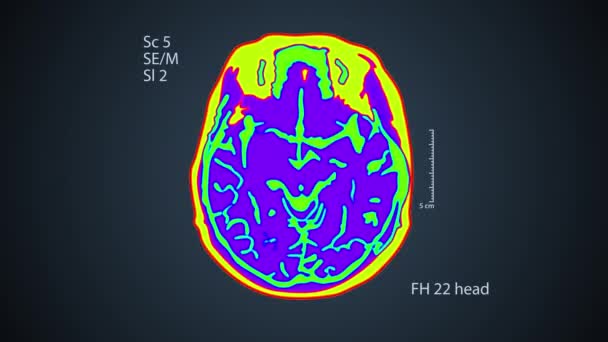 Rastreamento cerebral. Uma vista na tela. fundo colorido médico 4k — Vídeo de Stock