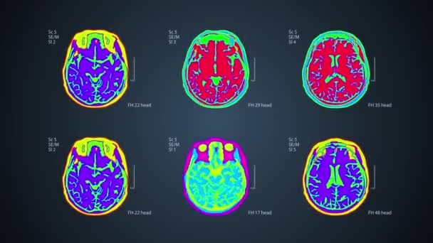 Scan MRT otak. 6 tampilan pada satu layar. Latar belakang berwarna-warni medis 4k — Stok Video