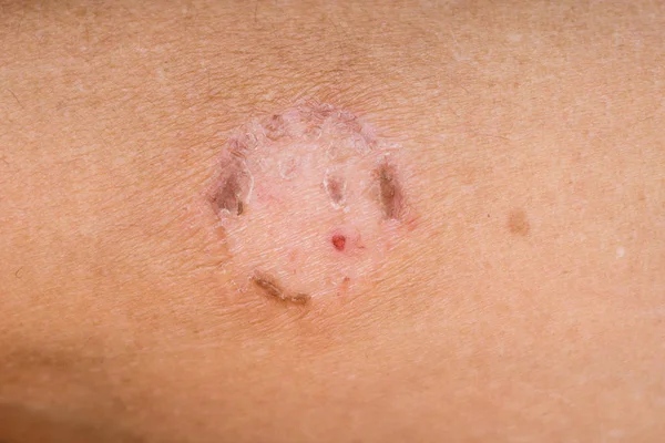 Herpes on the skin of man. Infectious skin disease